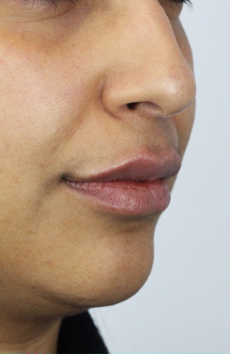 Lip Fillers Edmonton After