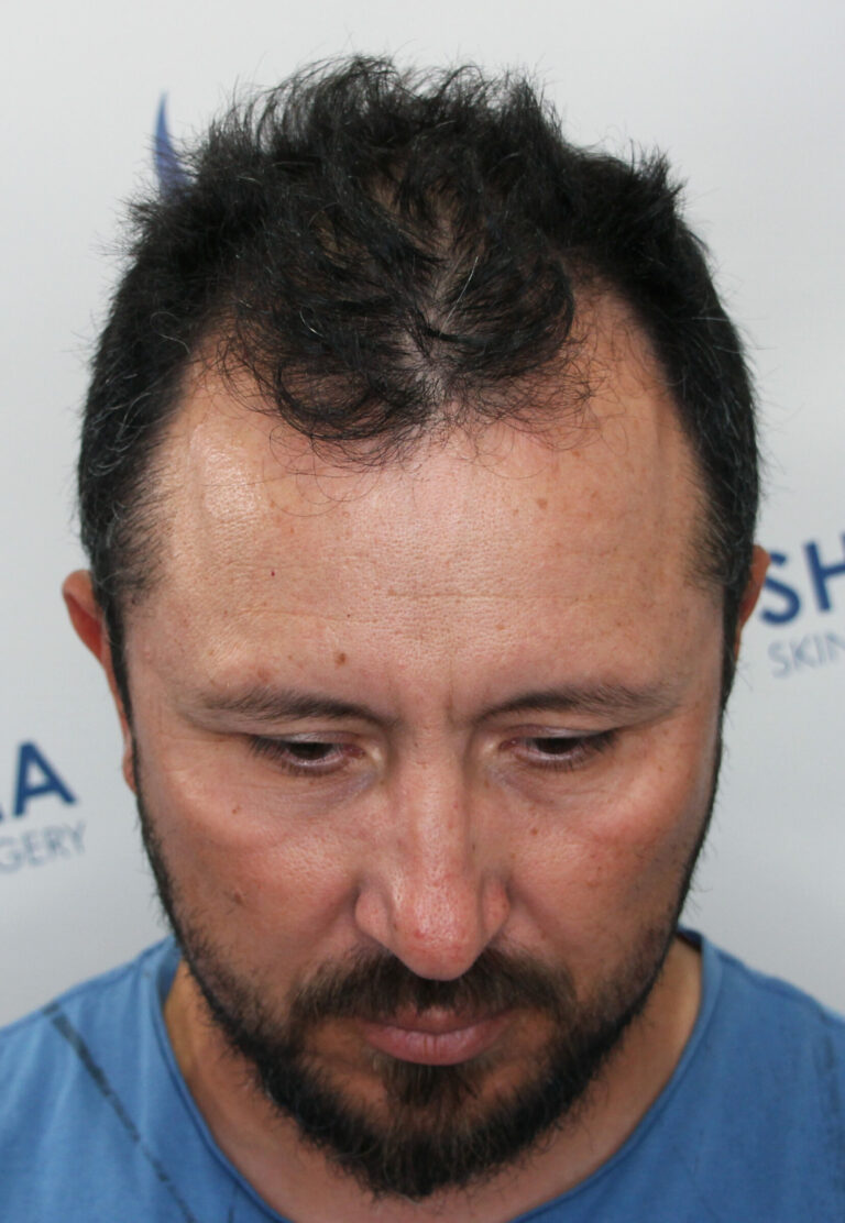 Before an FUE hair transplant in Edmonton, Alberta