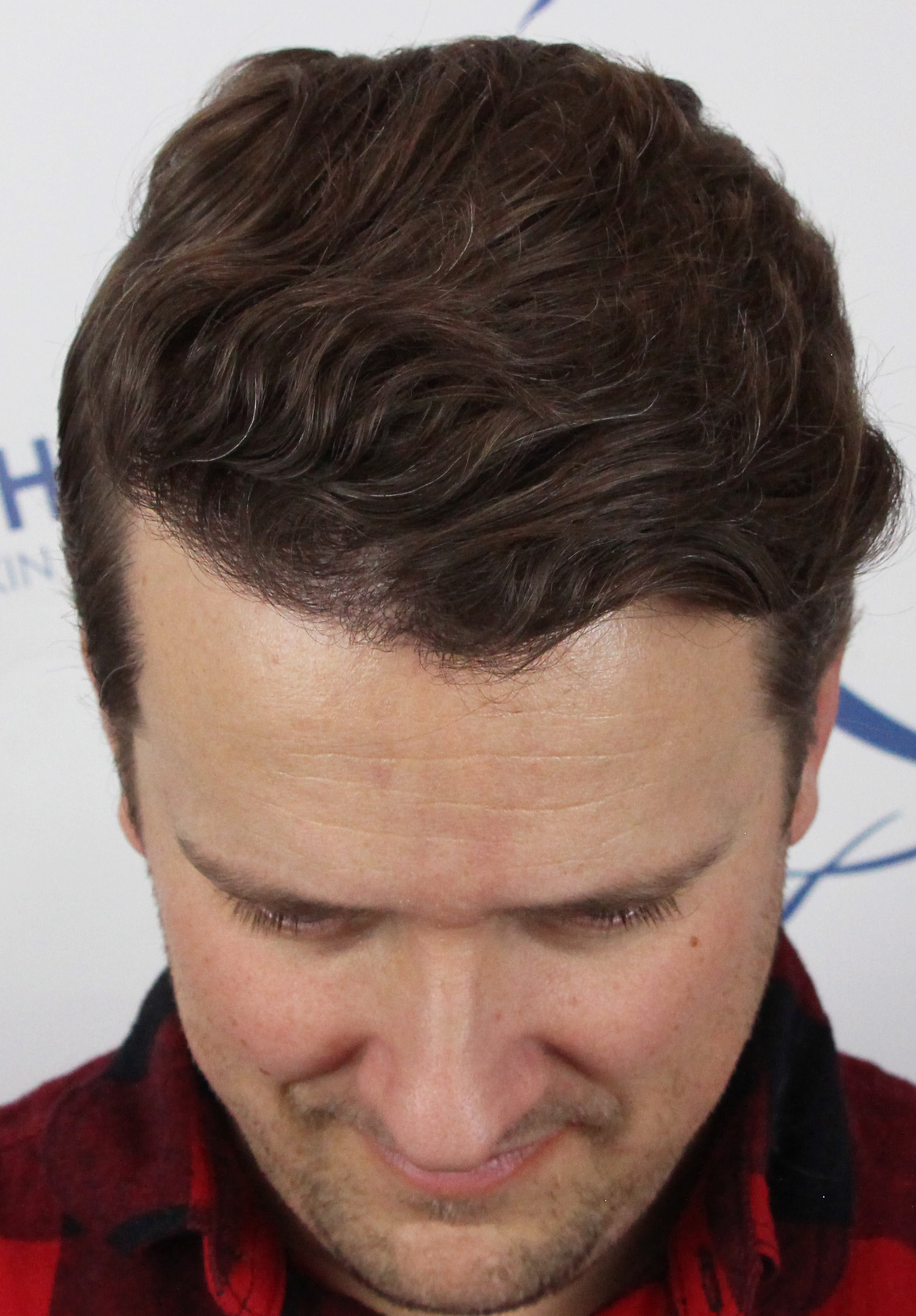 Hair line transplant Edmonton, Canada