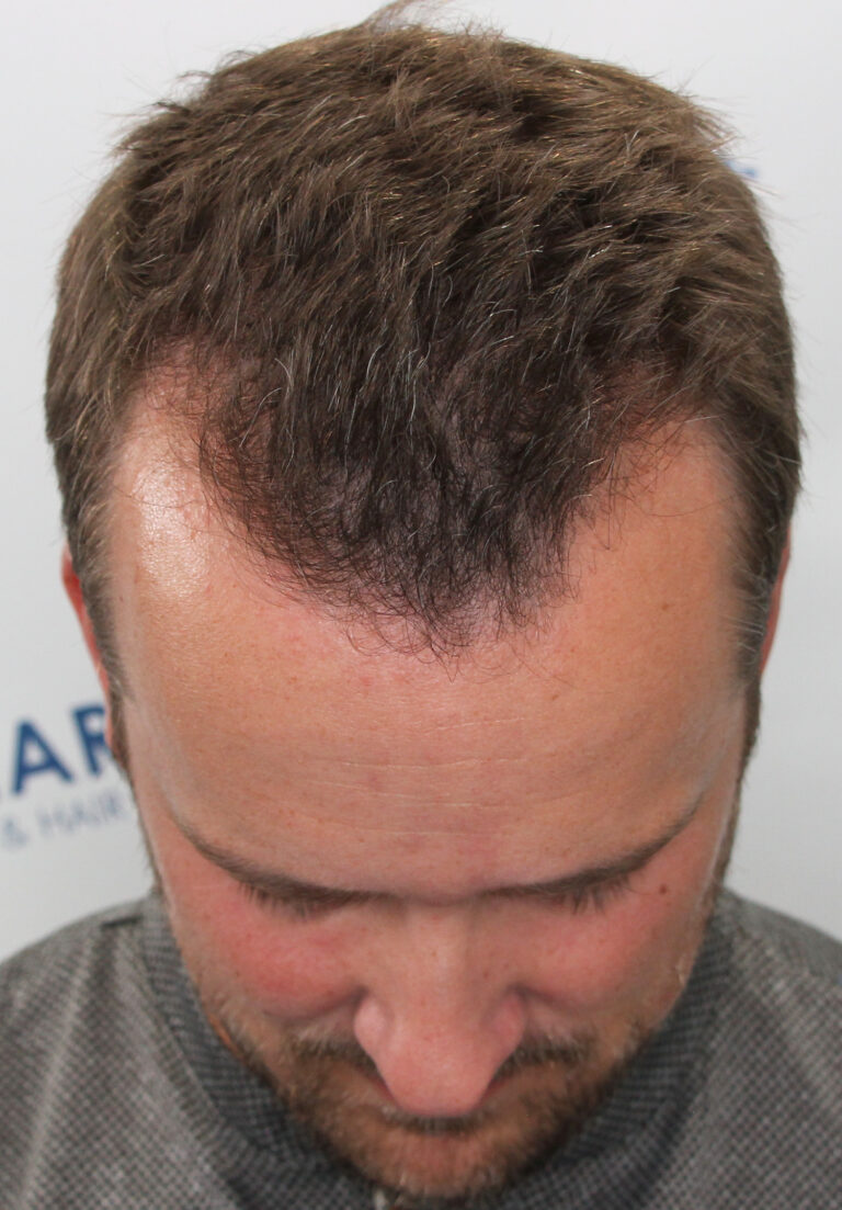 Hair line transplant Before