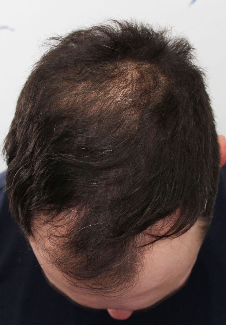 hair line restoration