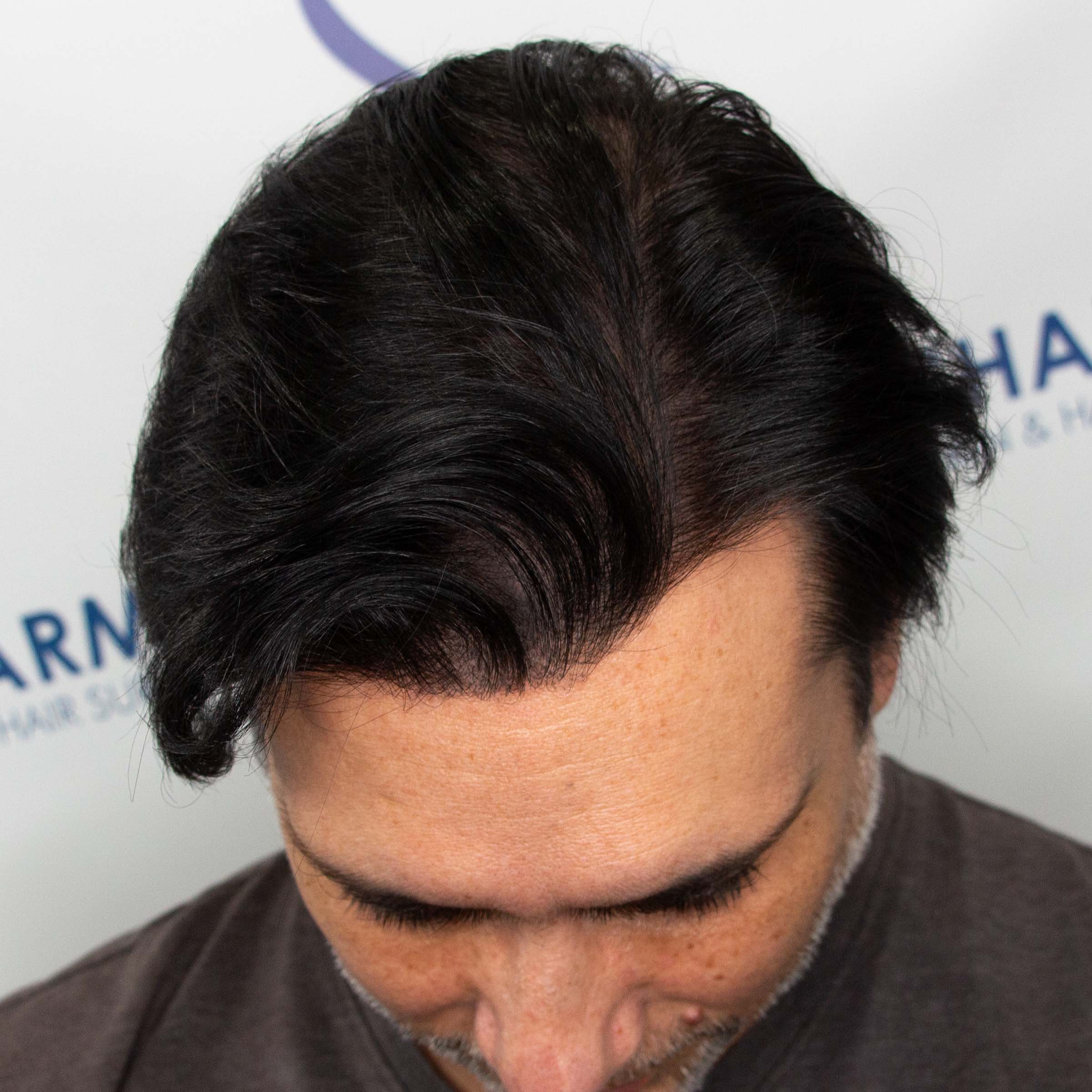 FUE hair transplant results in Edmonton, Canada