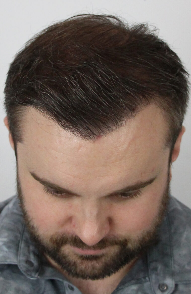 After an FUE hair transplant in Edmonton, Alberta
