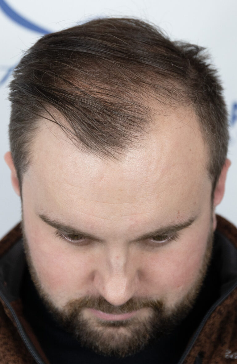 Before an FUE hair transplant in Edmonton, Alberta