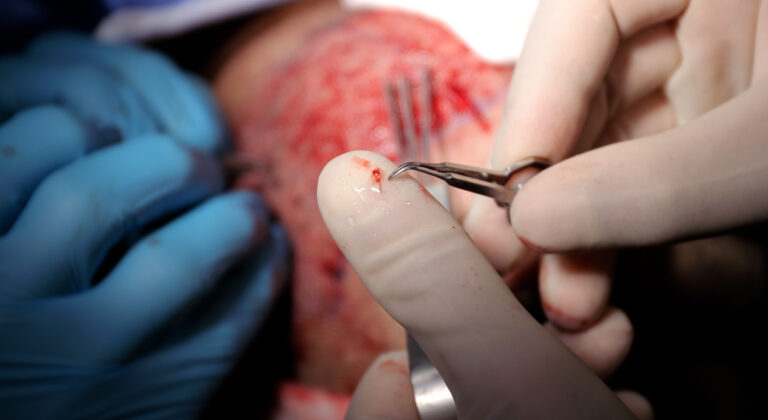 A hair graft from an FUE hair transplant in Edmonton, Alberta, Canada.