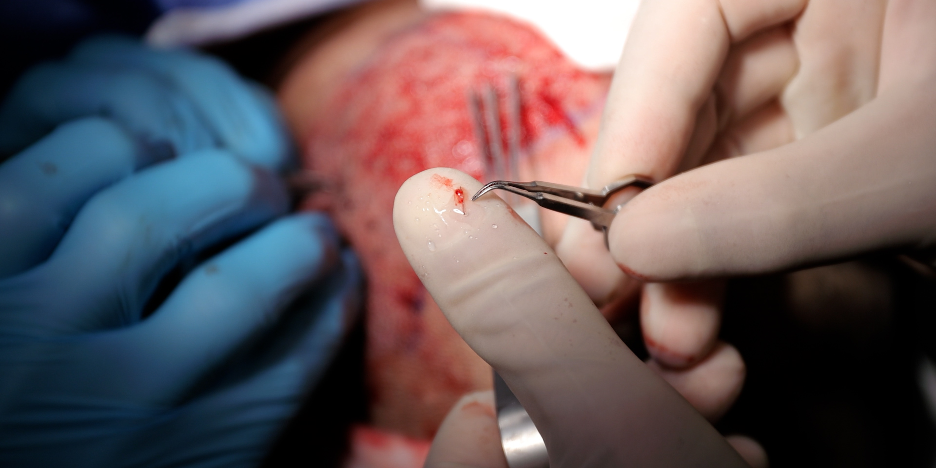 A hair graft from an FUE hair transplant in Edmonton, Alberta, Canada.