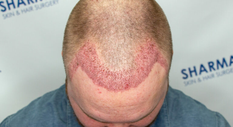 7 days post FUE hair transplant