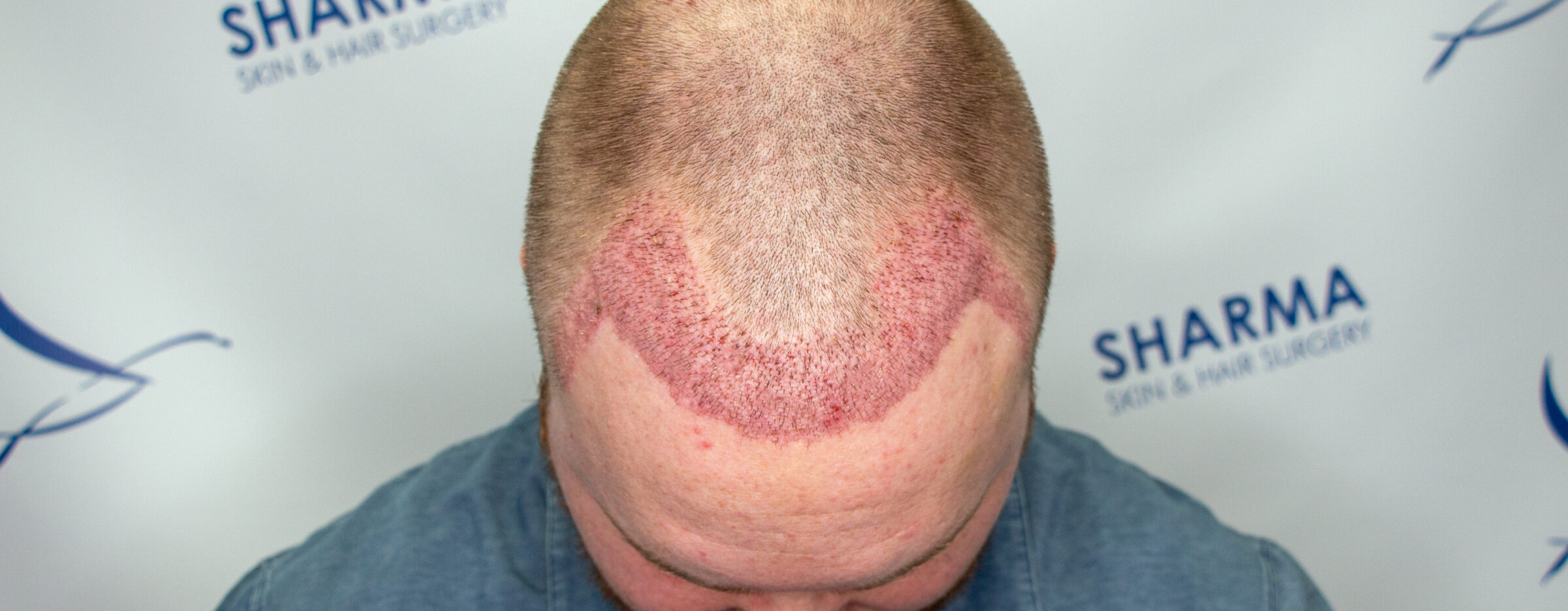 7 days post FUE hair transplant